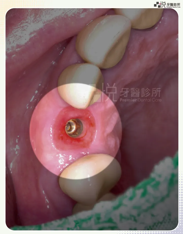 案例提供：饒庭伃醫師 品悅牙醫