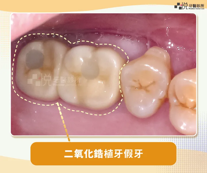 二氧化鋯植牙假牙
案例提供：饒庭伃 醫師 品悅牙醫