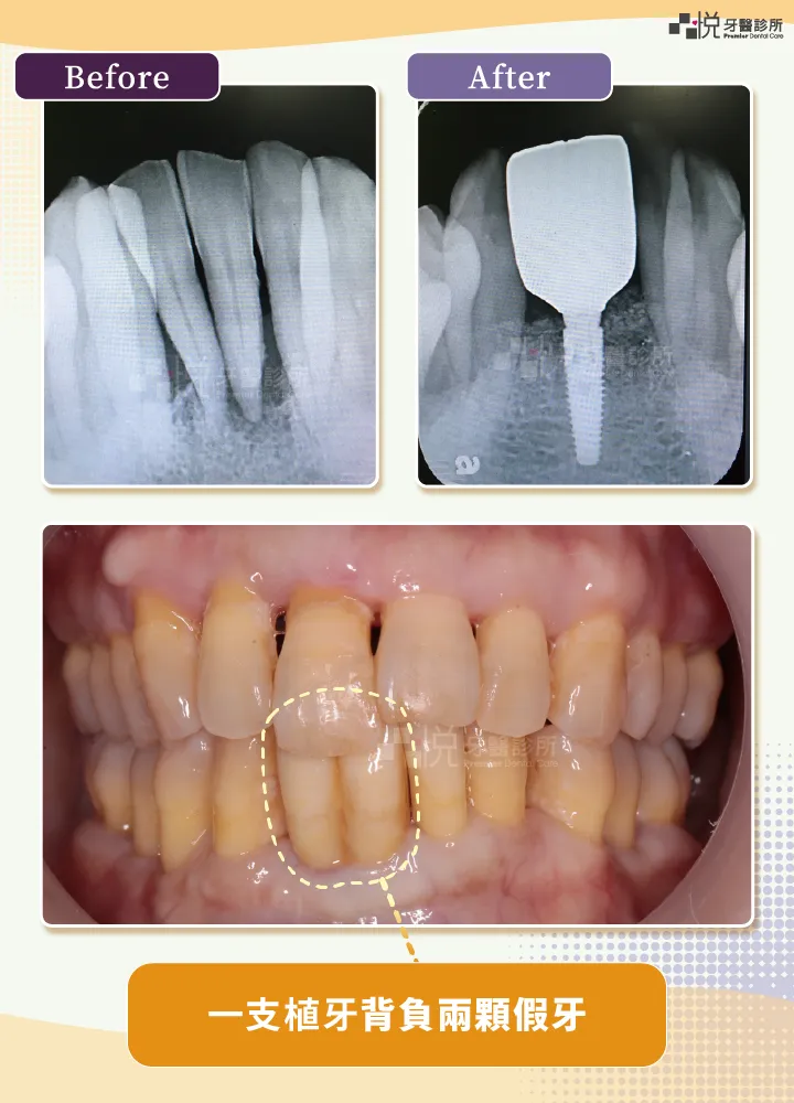 因牙周病拔除下前牙兩顆，因為空間不足，只夠植一顆牙根，背負兩顆假牙
案例提供：饒庭伃 醫師 品悅牙醫