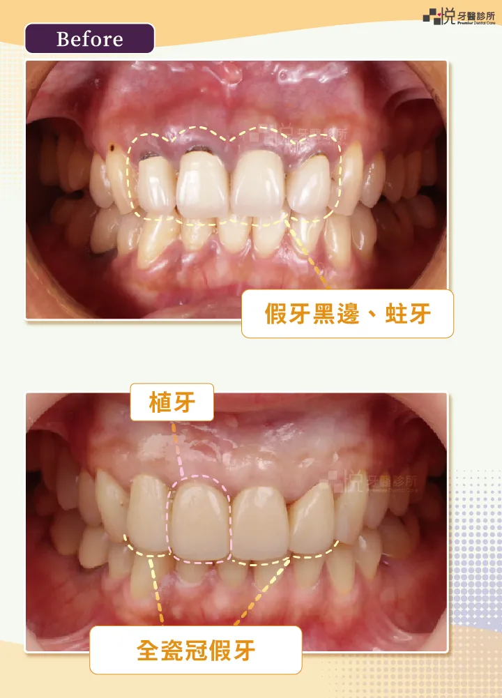 ｜術前｜前牙四顆舊假牙黑邊、蛀牙
｜術後｜全瓷冠假牙、植牙
案例提供：饒庭伃醫師 品悅牙醫