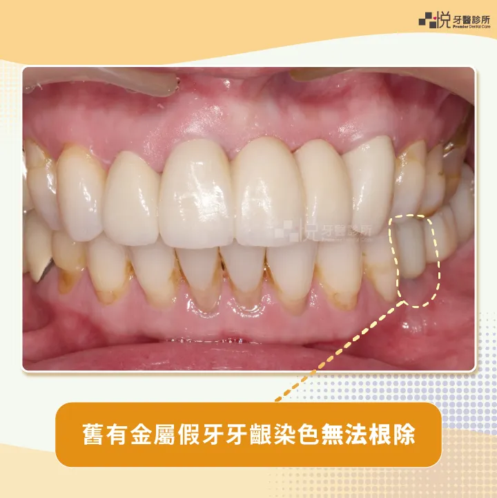 舊有金屬假牙造成的牙齦染色無法完全去除
案例提供：饒庭伃 醫師 品悅牙醫