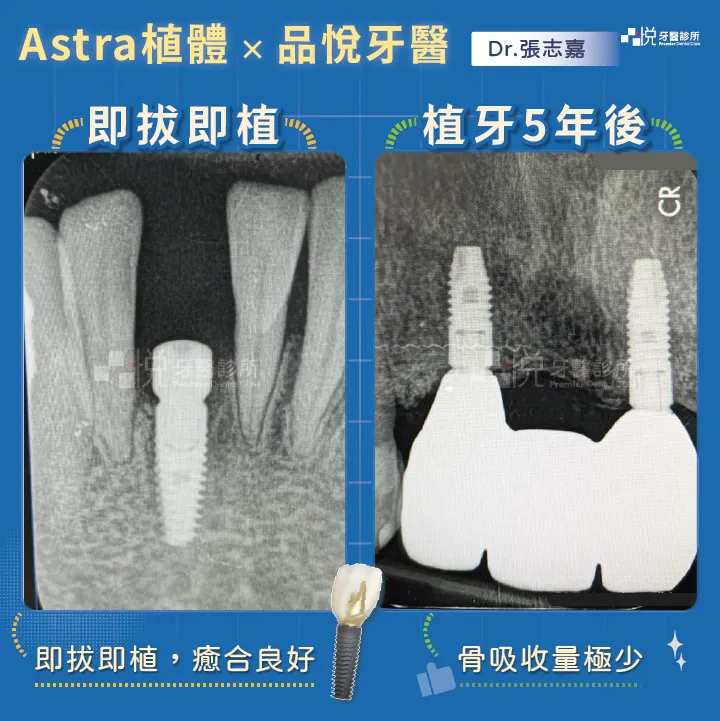 案例提供:張志嘉醫師 品悅牙醫
