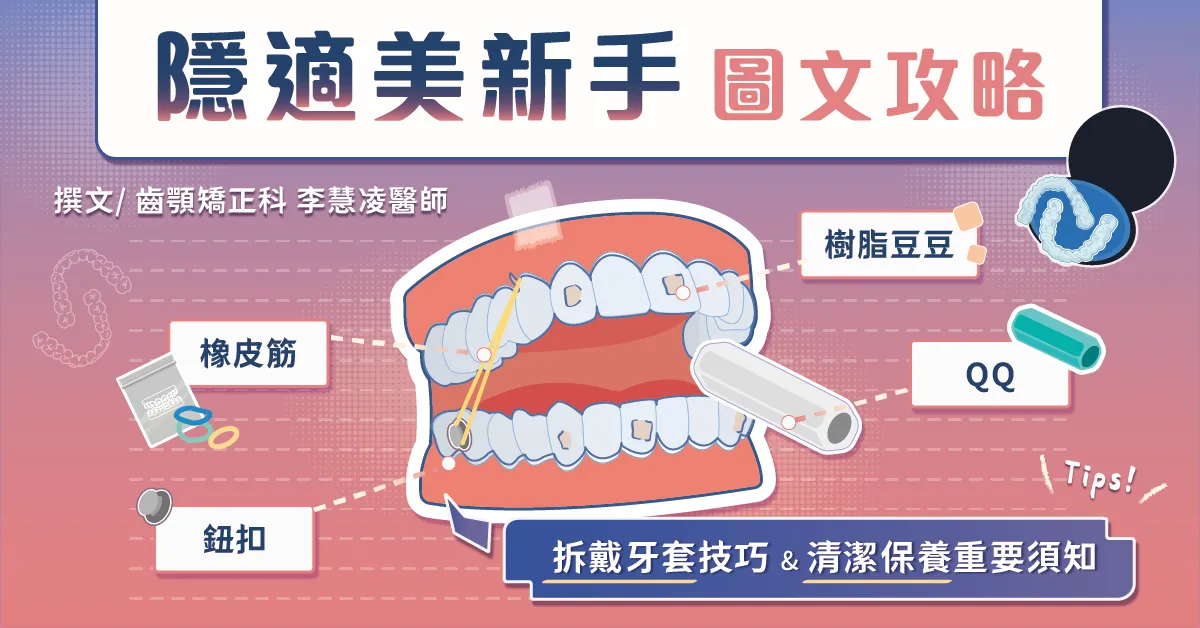 隱適美新手攻略：豆豆/QQ/鈕扣/橡皮筋、拆戴牙套技巧、清潔須知