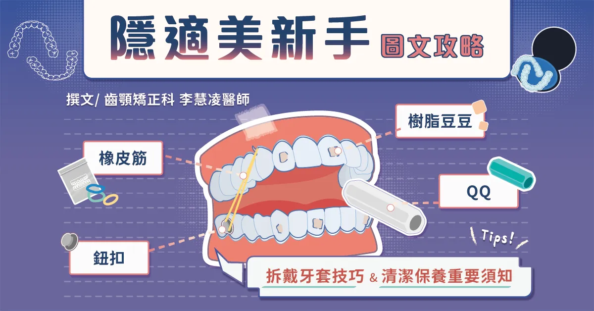 隱適美新手攻略：豆豆/QQ/鈕扣/橡皮筋、拆戴牙套技巧、清潔須知