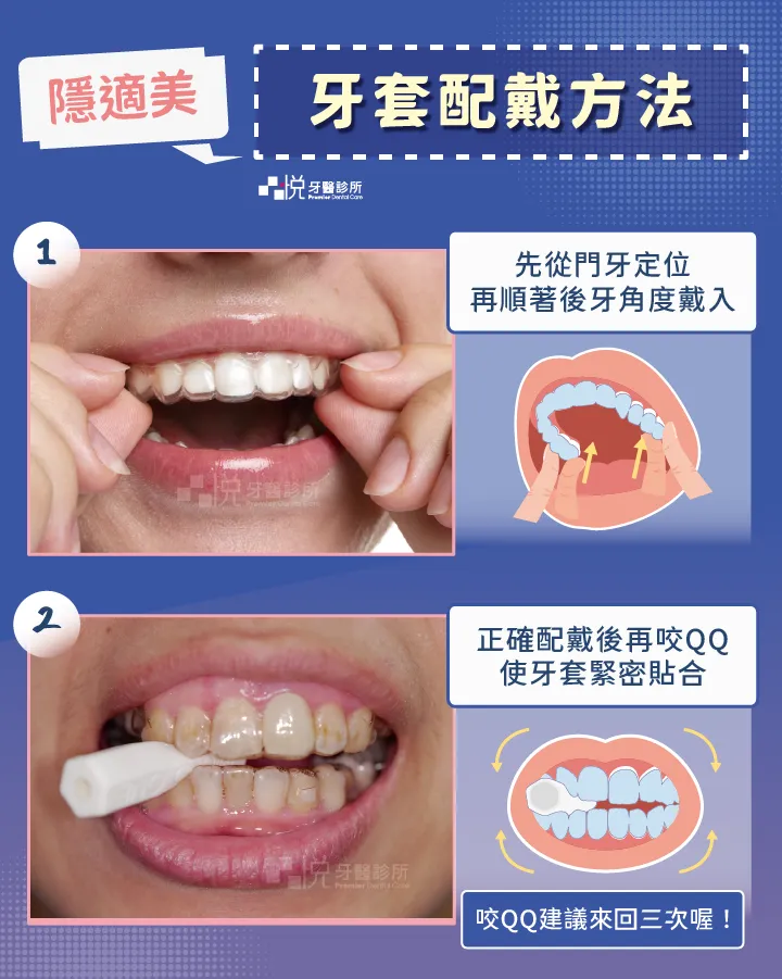 隱適美牙套對準牙齒後，由前牙先定位置入，再順著後牙的角度戴進牙套，待牙套完全戴至正確位置後才得以咬合及咬QQ，避免牙套因位置錯誤而咬到變形。
圖片來源：李慧凌醫師 品悅牙醫