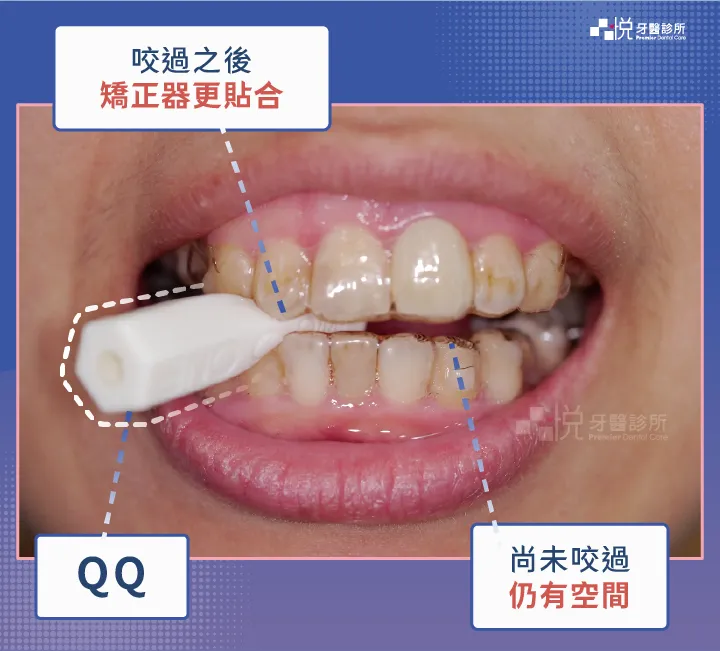 通常剛換新牙套的2-3天會較為不密合，此時可於有空隙不密合處牙齒加強咬QQ，如幾天後還是未改善，可拍照傳至診所，由醫師協助確認。
圖片來源：李慧凌醫師 品悅牙醫