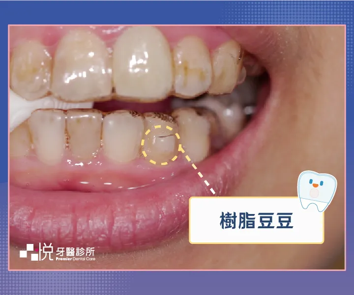 隱適美豆豆