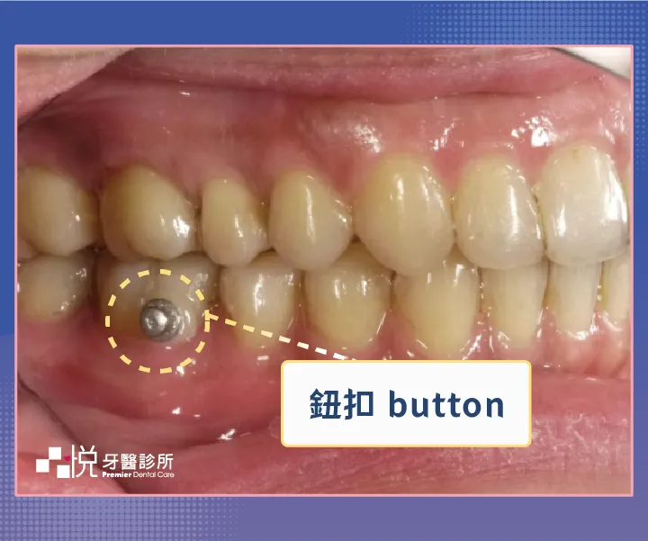 隱適美的鈕扣是黏在牙齒表面上。