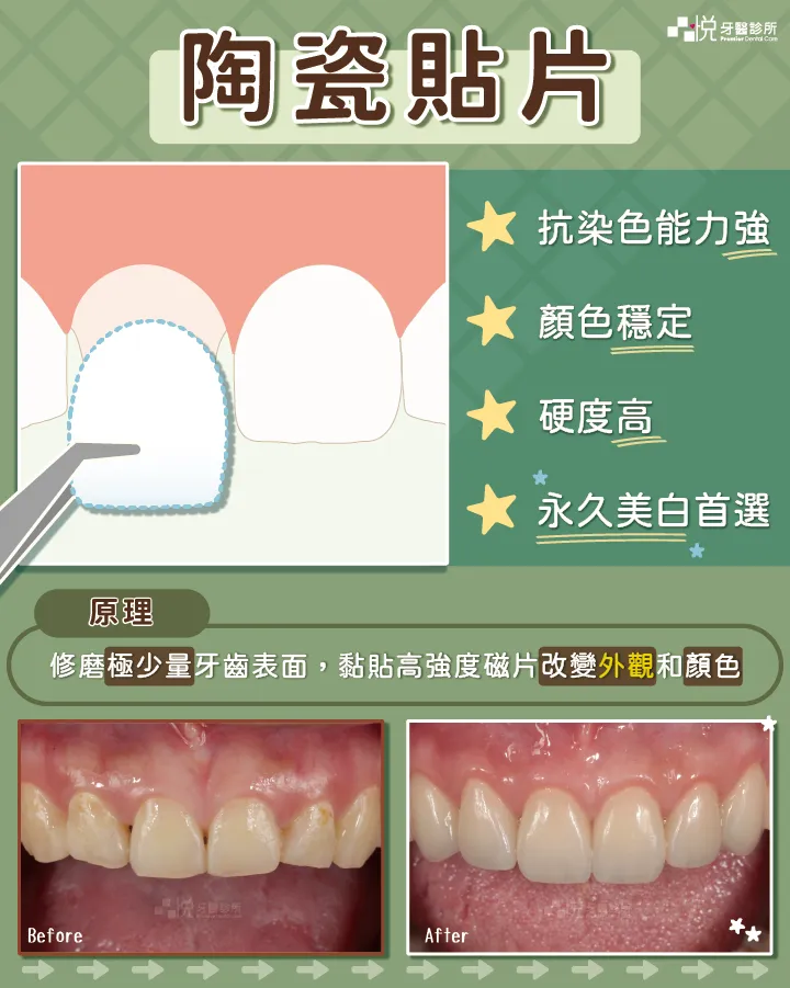 陶瓷貼片說明｜品悅牙醫蘇裕隆醫師，抗染色能力高、顏色穩定、硬度高、用久美白首選