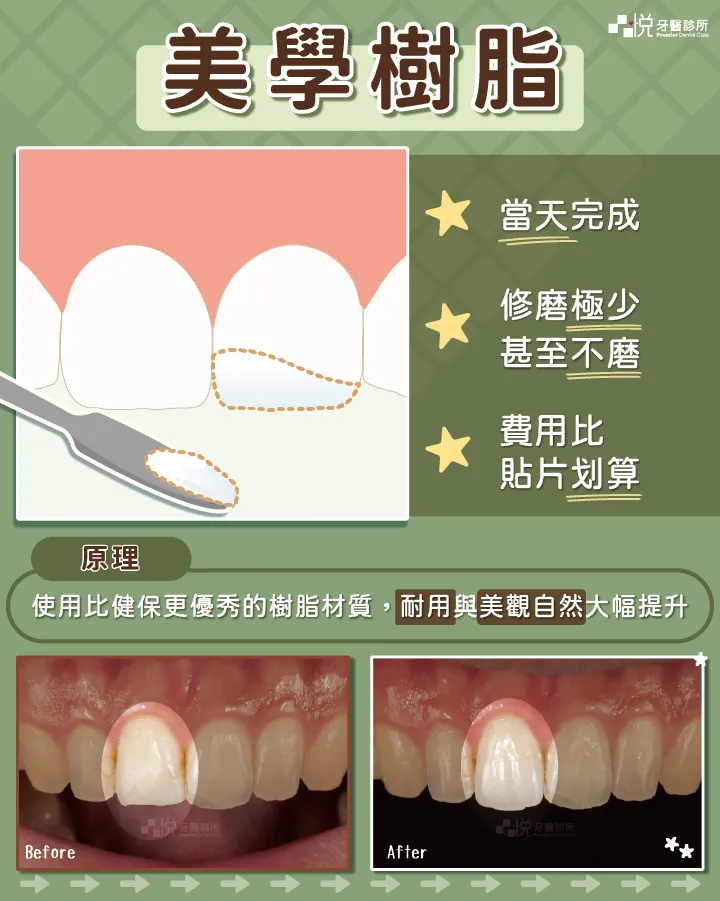 美學樹脂說明｜品悅牙醫蘇裕隆醫師，當天完成、修磨極少、費用較划算