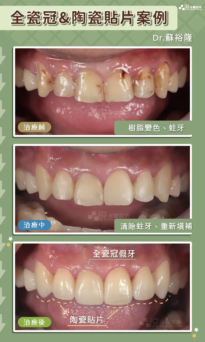全瓷冠＆陶瓷貼片案例｜案例提供：蘇裕隆醫師 品悅牙醫