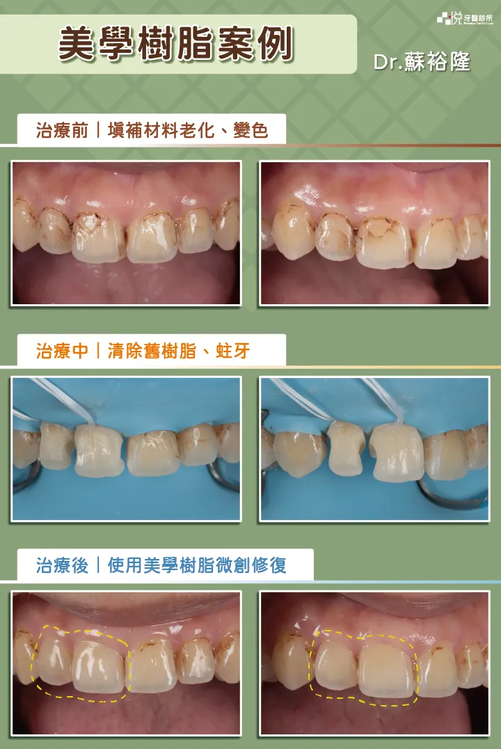 美學樹脂案例，品悅牙醫蘇裕隆醫師