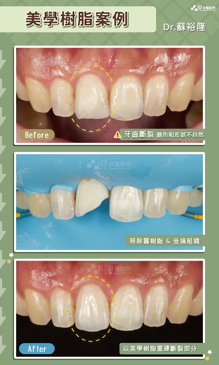 美學樹脂案例，品悅牙醫蘇裕隆醫師