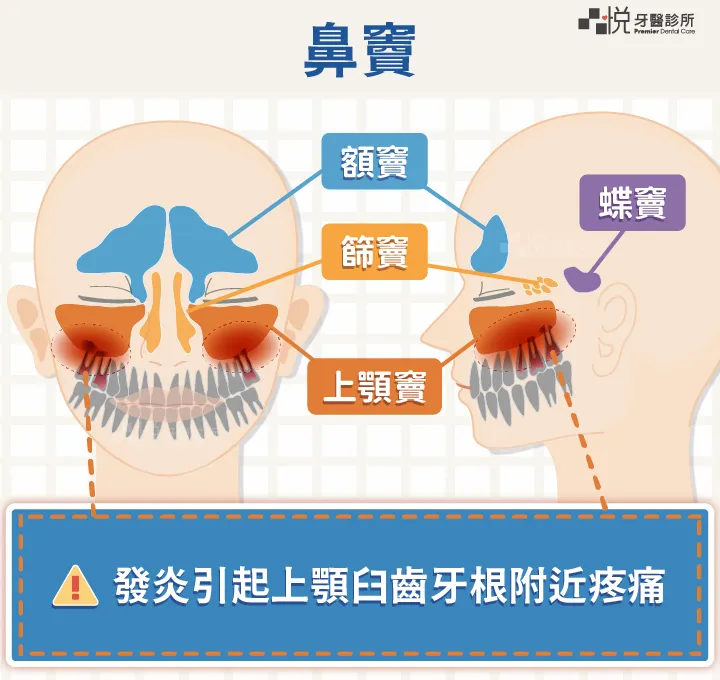 上顎竇就在上排臼齒的上方，若有發炎不是也會引起臼齒附近的疼痛。