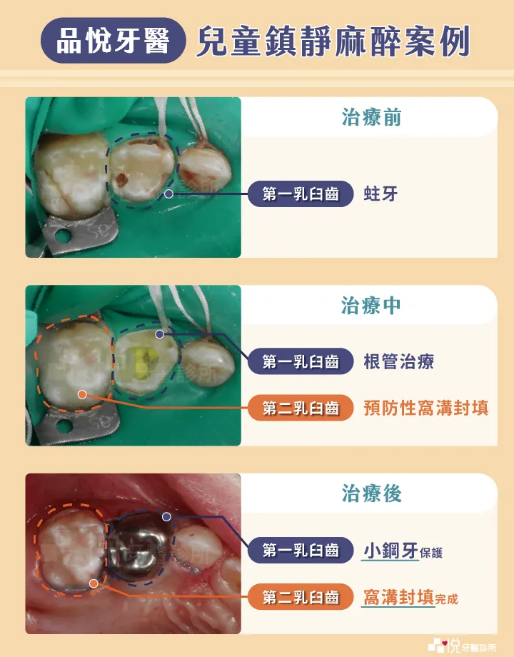 術前:第一乳臼齒蛀牙,術中:第一乳臼齒根管治療&第二乳臼齒預防性窩溝封填,術後:乳牙第一臼齒給予小鋼牙保護
案例提供:徐逸竹醫師 品悅牙醫