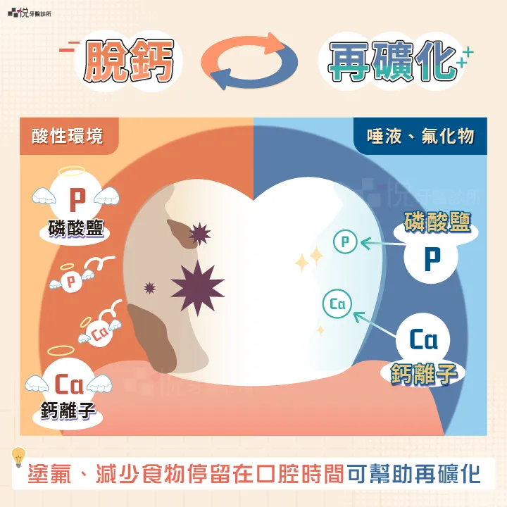 齲齒(蛀牙)是動態累積的過程,不斷重複「脫鈣(礦)」與「再礦化」,當脫鈣 > 再礦化便會產生齲損。