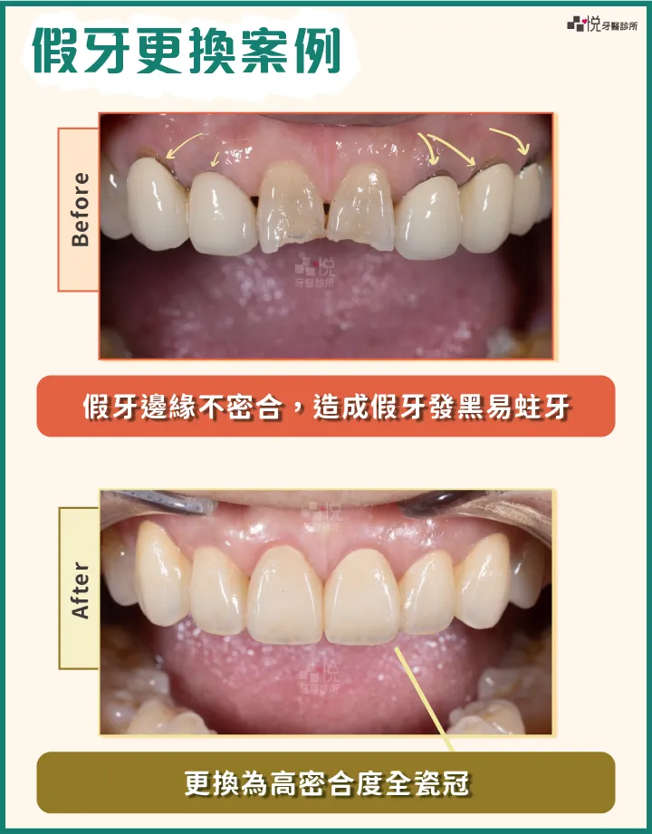 假牙更換成全瓷冠案例|案例提供:趙子睿醫師 品悅牙醫