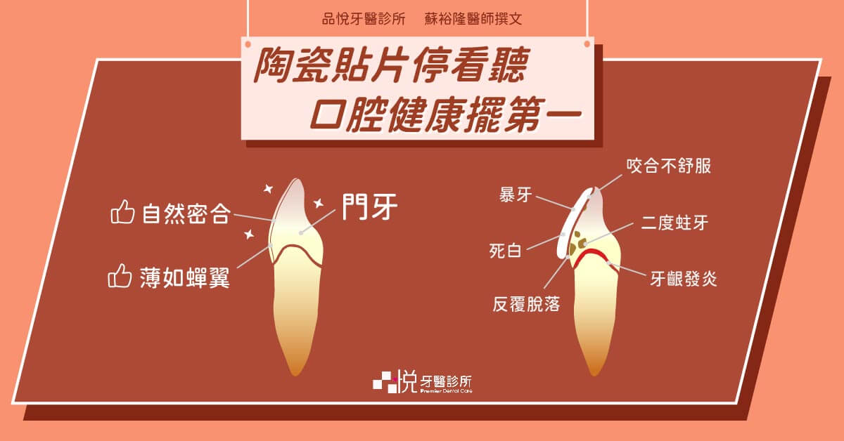 美白貼片暴牙與磨牙陶瓷貼片對比