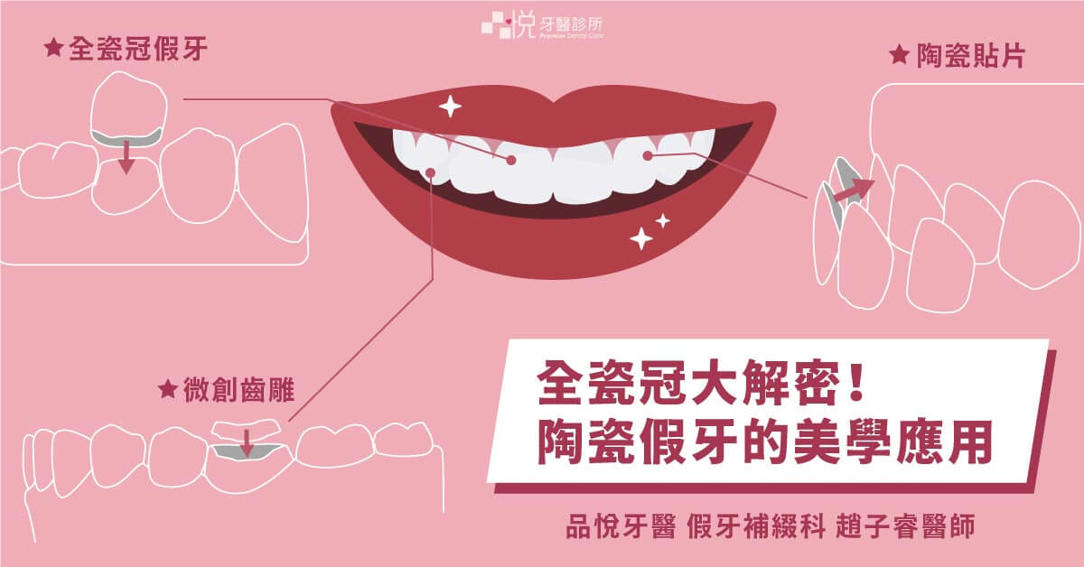 全瓷冠大解密！全瓷假牙的美學應用：假牙、貼片、微創齒雕