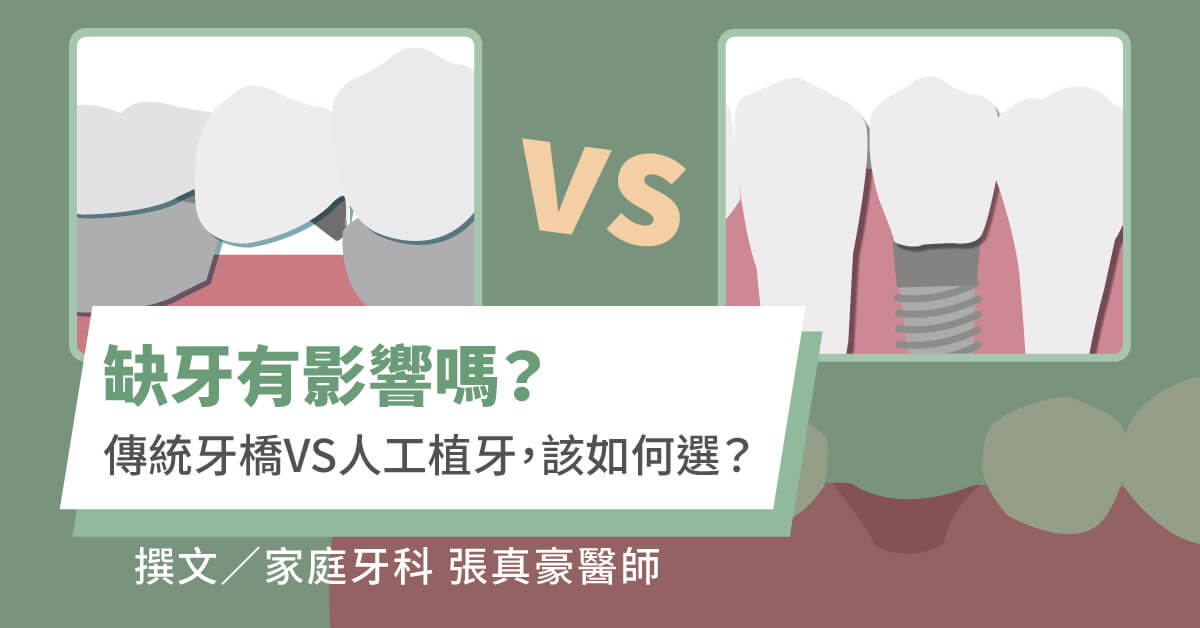 缺牙有影響嗎？傳統牙橋VS人工植牙，如何選？【竹北植牙推薦】