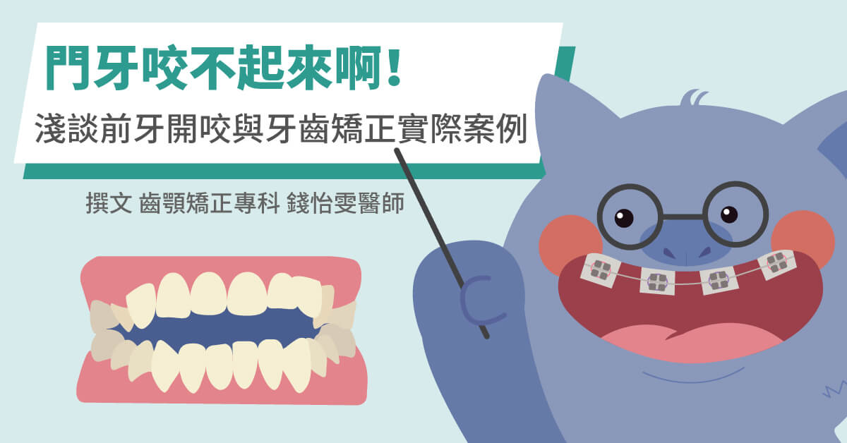 門牙咬不起來啊！淺談前牙開咬與牙齒矯正實際案例