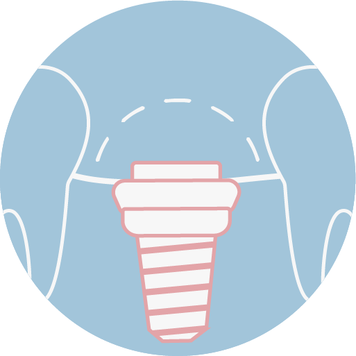 嚴選國內外植體大廠牌