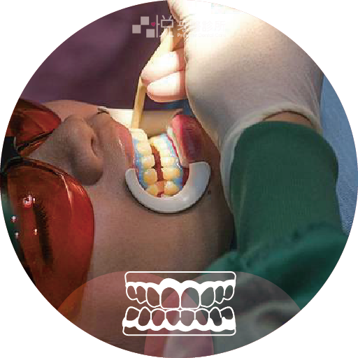 ❸ 塗牙齦保護劑