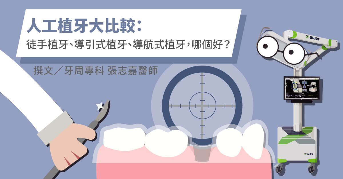 植牙大比較：徒手植牙、導引式植牙、導航式植牙【竹北植牙推薦】