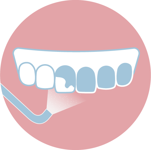 ❷ 進行噴砂美白，透過高壓氣流將碳酸氫鈉噴至牙齒表面