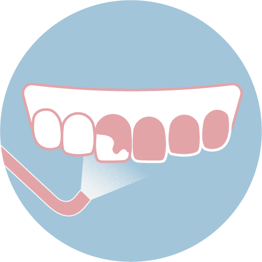 ❷ 進行噴砂美白，透過高壓氣流將碳酸氫鈉噴至牙齒表面