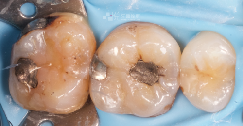 ① 拍攝X光後，發現舊有填補的銀粉下有二度蛀牙