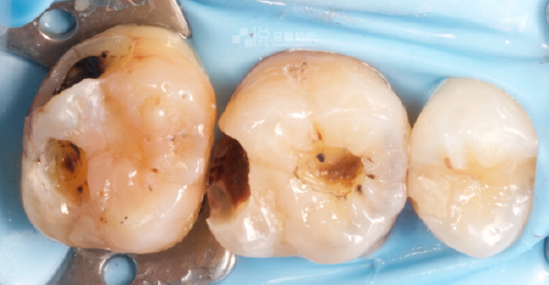 ② 將銀粉挖除後，發現大範圍蛀牙