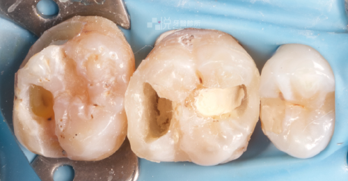 ③ 將蛀牙都挖除乾淨，並放入生醫材料【活隨保存術】