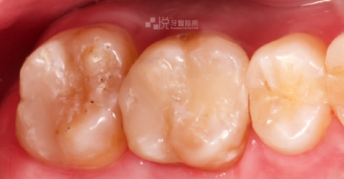 ④ 以高階美學樹脂補牙復型，完成治療