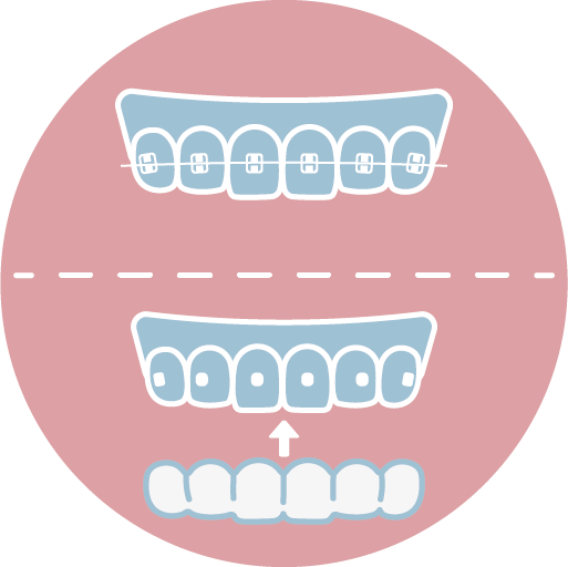 ❹ 開始矯正（約每4至6週回診調整，或每日按時配戴隱適美牙套）