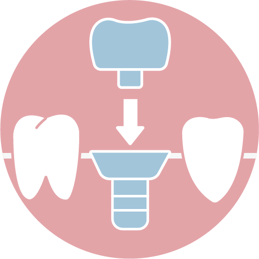 ❹ 裝戴植牙假牙
