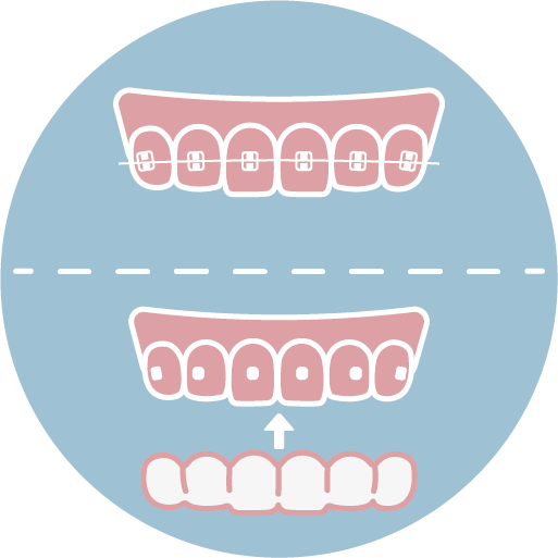 ❹ 開始矯正（約每4至6週回診調整，或每日按時配戴隱適美牙套）