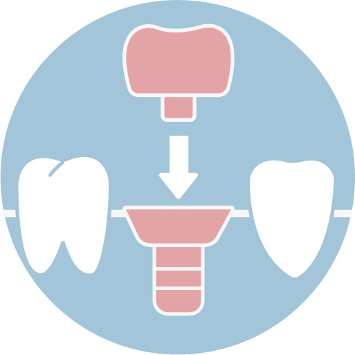 ❹ 裝戴植牙假牙