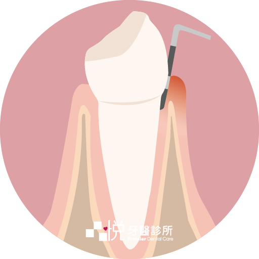 牙齦炎