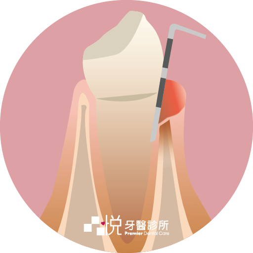 牙周病