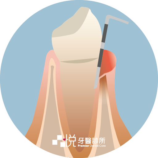 牙周病