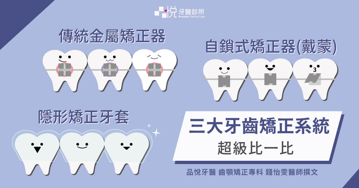 三大牙齒矯正系統「隱適美、戴蒙矯正、傳統矯正」優缺點比較
