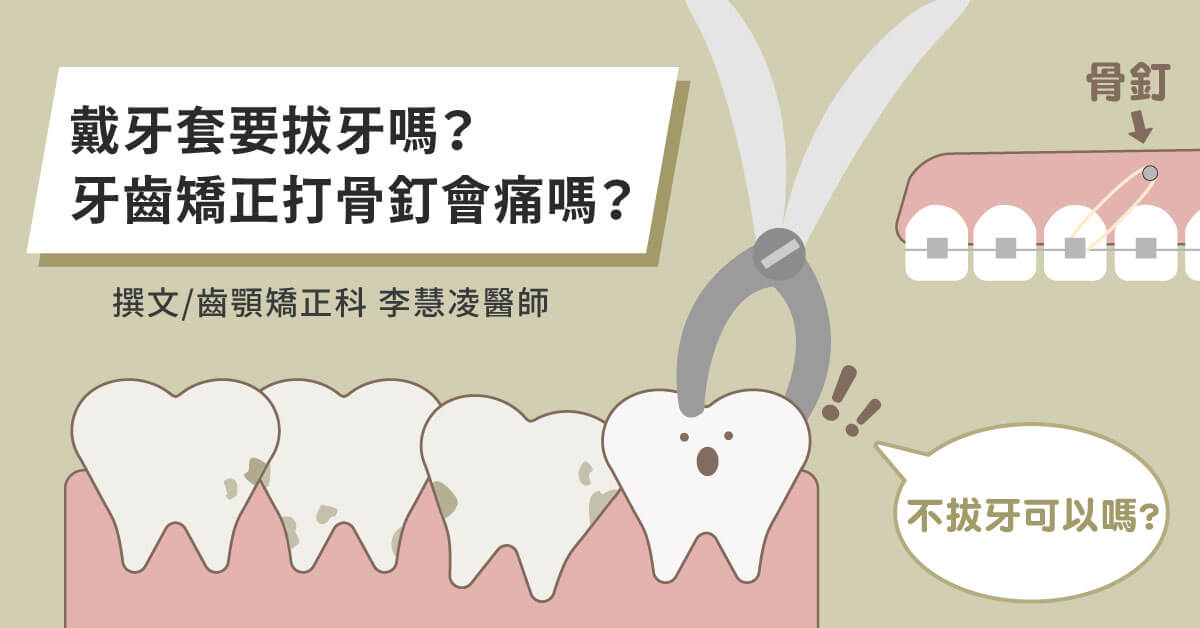 戴牙套要拔牙嗎？牙齒矯正打骨釘會痛嗎？【竹北牙齒矯正推薦】