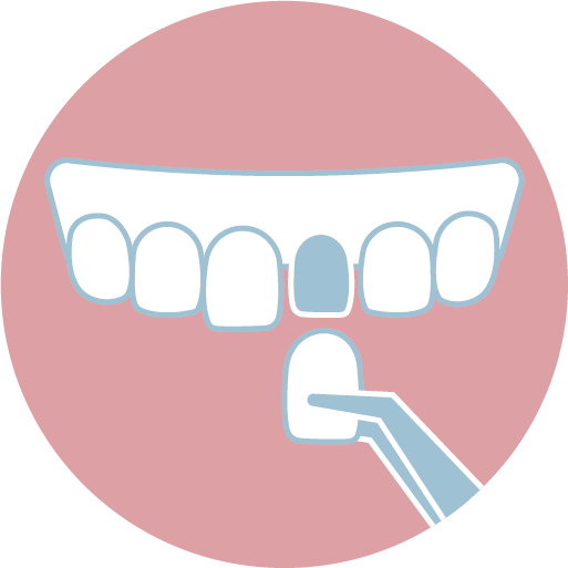 ❹ 陶瓷貼片製作、配戴與定期回診