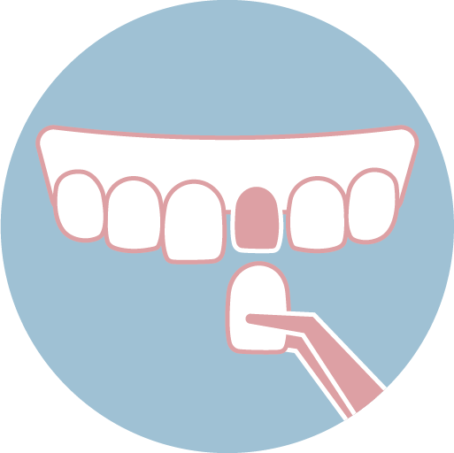 ❹ 陶瓷貼片製作、配戴與定期回診