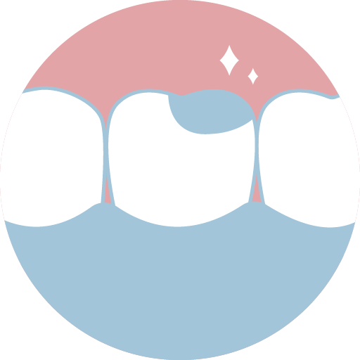 ❹ 醫師黏著微創齒雕，完成療程